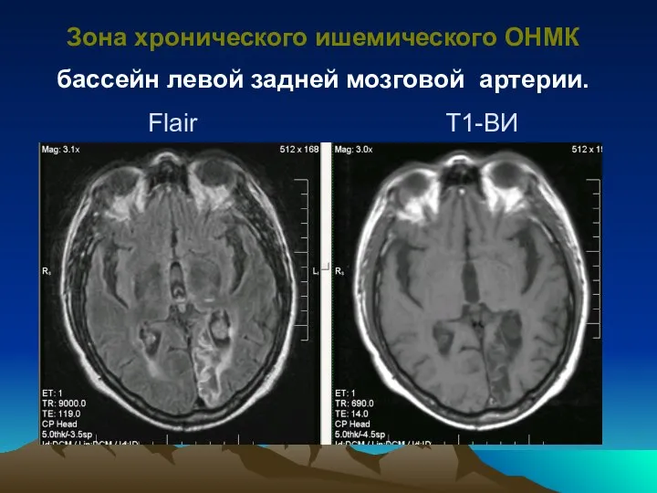 Зона хронического ишемического ОНМК бассейн левой задней мозговой артерии. Flair Т1-ВИ