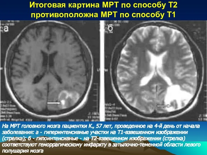 Итоговая картина МРТ по способу Т2 противоположна МРТ по способу T1