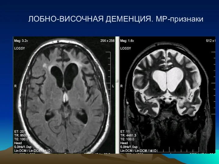 ЛОБНО-ВИСОЧНАЯ ДЕМЕНЦИЯ. МР-признаки