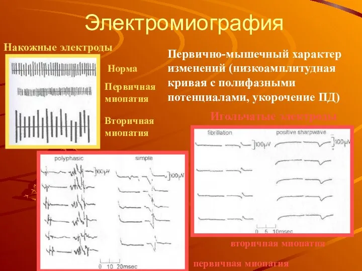 Электромиография Накожные электроды Игольчатые электроды Норма Первичная миопатия Вторичная миопатия первичная