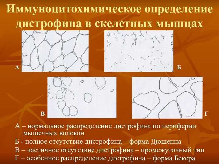 Иммуноцитохимическое определение дистрофина в скелетных мышцах А – нормальное распределение дистрофина