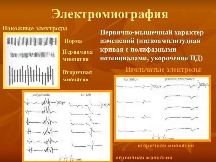 Электромиография Накожные электроды Игольчатые электроды Норма Первичная миопатия Вторичная миопатия первичная