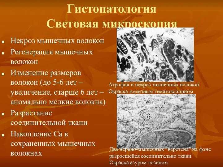 Гистопатология Световая микроскопия Некроз мышечных волокон Регенерация мышечных волокон Изменение размеров