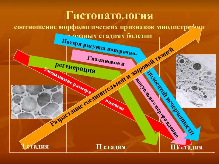 Гистопатология соотношение морфологических признаков миодистрофии в разных стадиях болезни III стадия