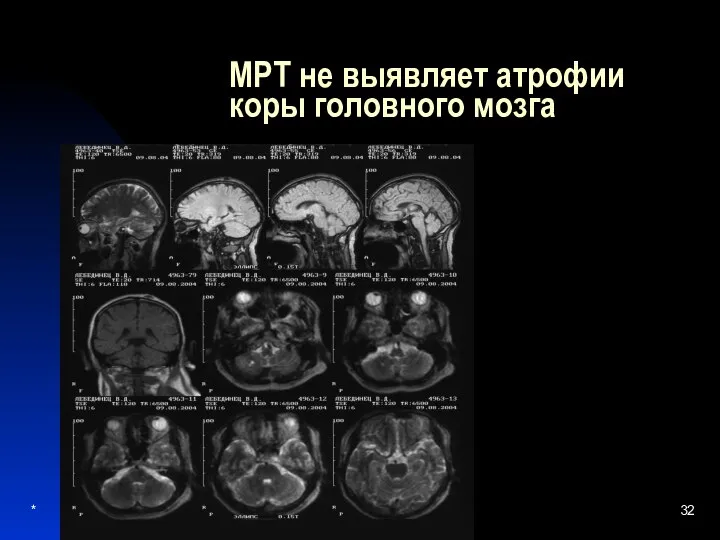 * МРТ не выявляет атрофии коры головного мозга