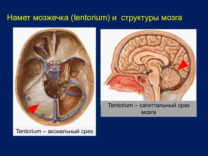 Намет мозжечка (tentorium) и структуры мозга Tentorium – аксиальный срез Tentorium – сагиттальный срез мозга