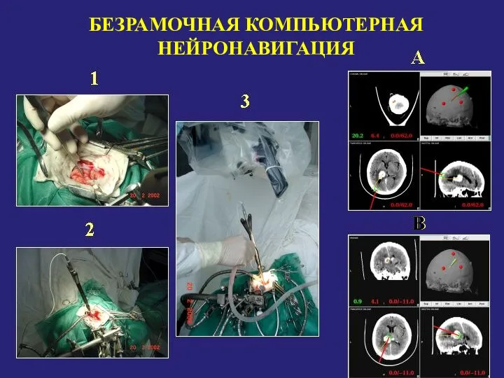 1 3 2 B БЕЗРАМОЧНАЯ КОМПЬЮТЕРНАЯ НЕЙРОНАВИГАЦИЯ