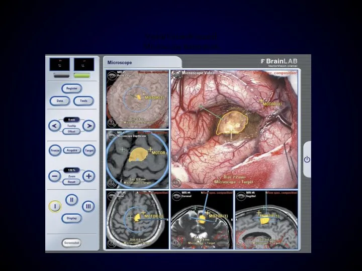 VectorVision® cranial Microscope Integration (Image courtesey of West Virginia University, Morgantown