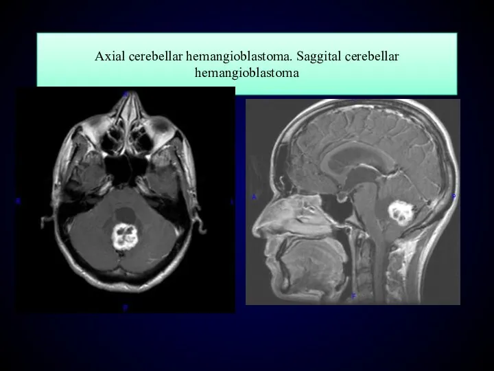 Axial cerebellar hemangioblastoma. Saggital cerebellar hemangioblastoma