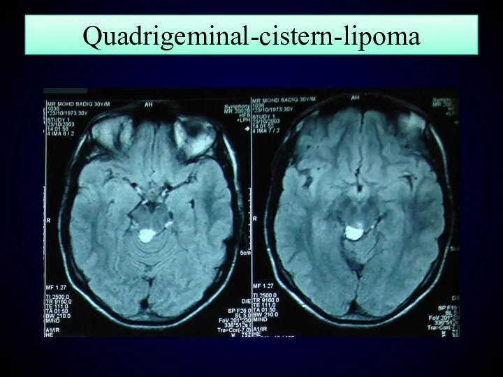 Quadrigeminal-cistern-lipoma