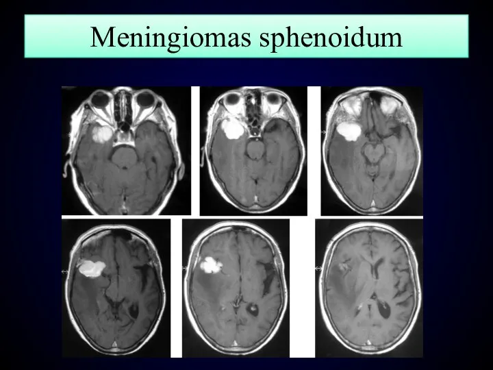 Meningiomas sphenoidum