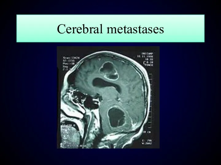 Cerebral metastases