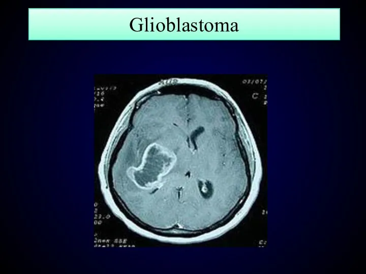 Glioblastoma