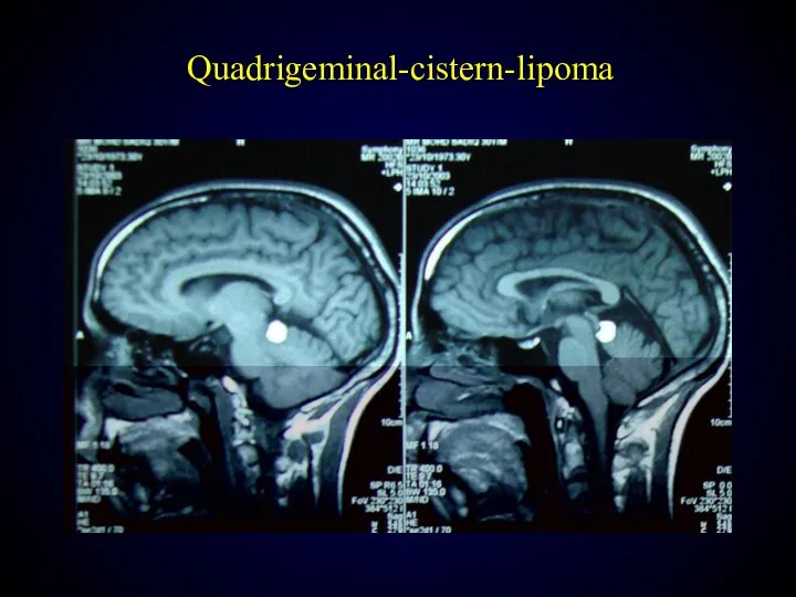 Quadrigeminal-cistern-lipoma