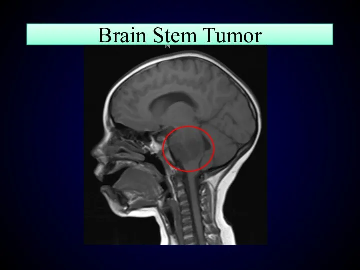 Brain Stem Tumor