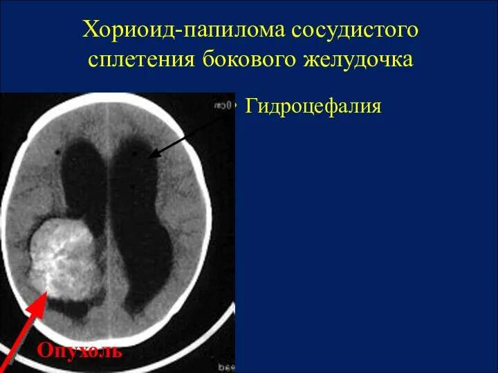 Хориоид-папилома сосудистого сплетения бокового желудочка Гидроцефалия Опухоль