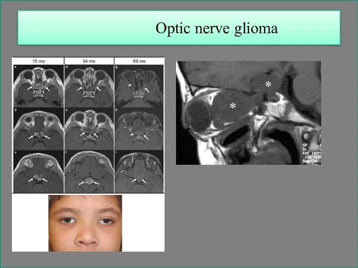 Optic nerve glioma