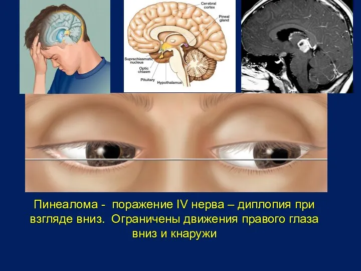 Пинеалома - поражение IV нерва – диплопия при взгляде вниз. Ограничены