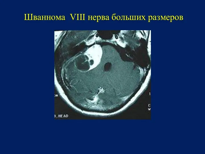 Шваннома VIII нерва больших размеров