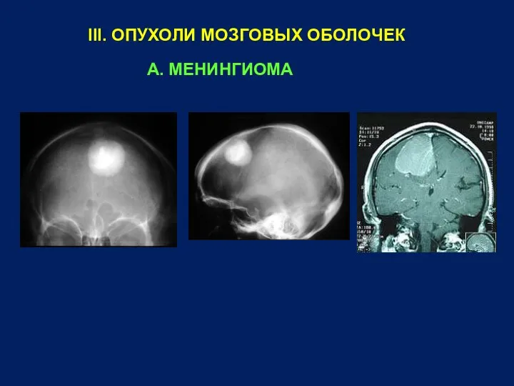 III. ОПУХОЛИ МОЗГОВЫХ ОБОЛОЧЕК А. МЕНИНГИОМА