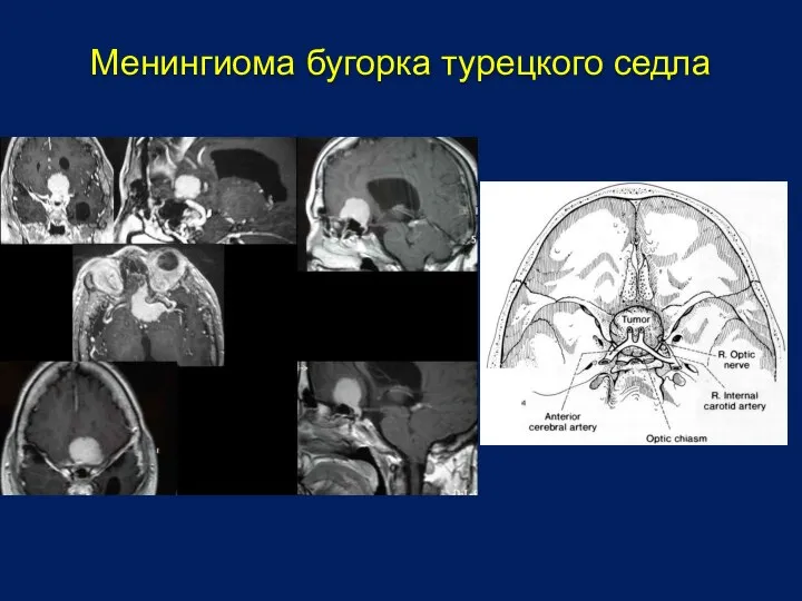 Менингиома бугорка турецкого седла