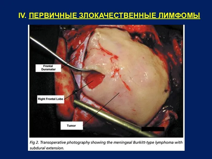 IV. ПЕРВИЧНЫЕ ЗЛОКАЧЕСТВЕННЫЕ ЛИМФОМЫ