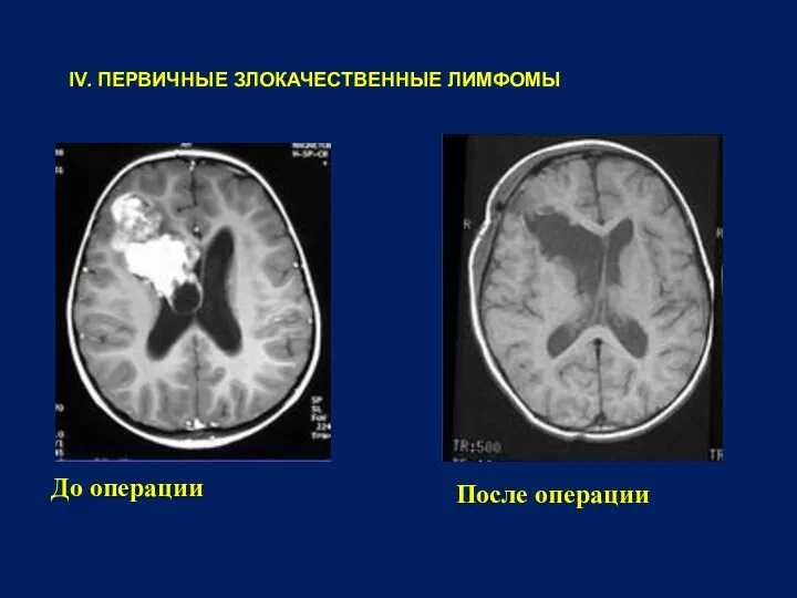 IV. ПЕРВИЧНЫЕ ЗЛОКАЧЕСТВЕННЫЕ ЛИМФОМЫ До операции После операции