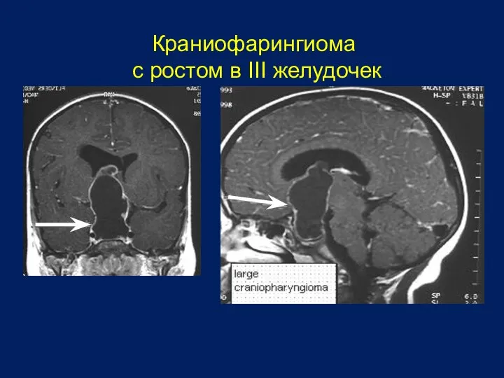 Краниофарингиома с ростом в III желудочек