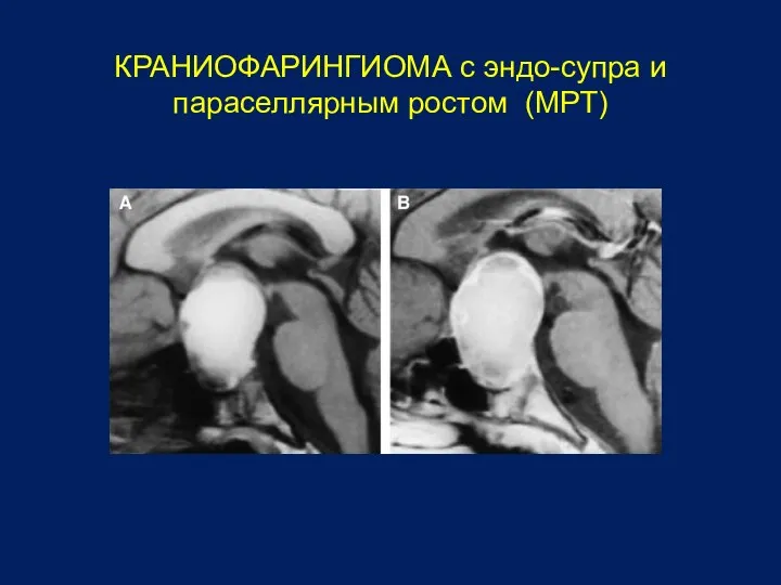 КРАНИОФАРИНГИОМА с эндо-супра и параселлярным ростом (МРТ)