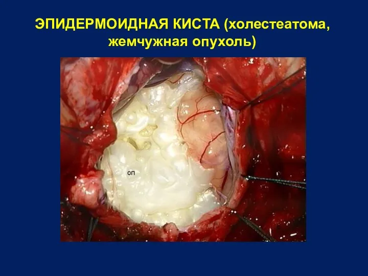 ЭПИДЕРМОИДНАЯ КИСТА (холестеатома, жемчужная опухоль)