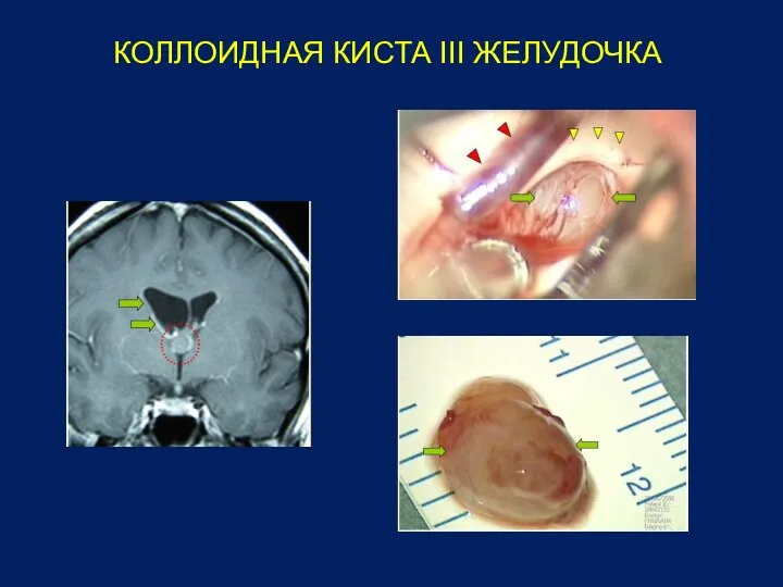 КОЛЛОИДНАЯ КИСТА III ЖЕЛУДОЧКА