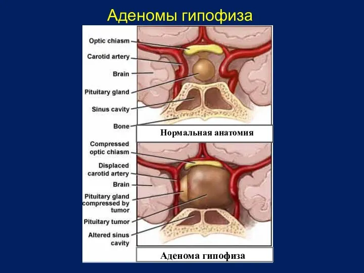 Аденомы гипофиза Нормальная анатомия Аденома гипофиза