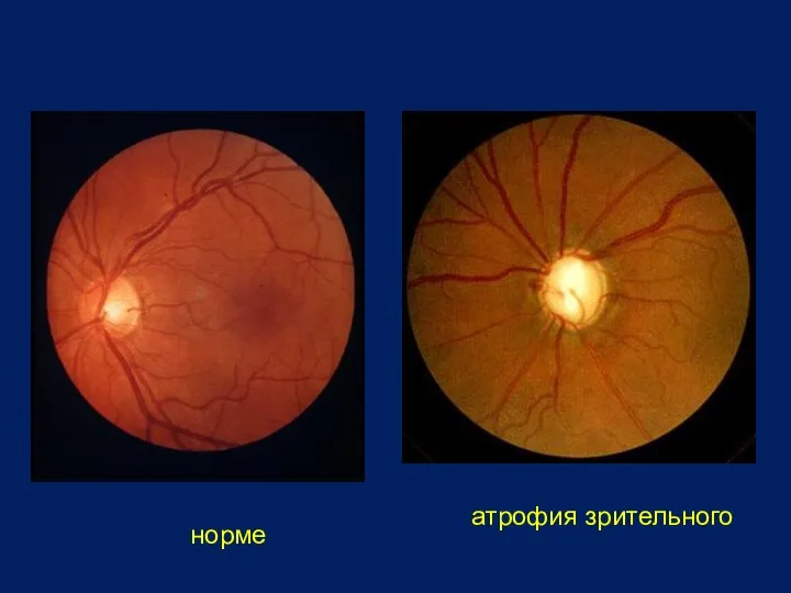 В норме Первичная (простая) атрофия зрительного нерва