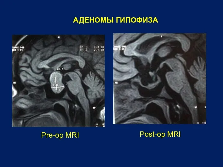 АДЕНОМЫ ГИПОФИЗА Pre-op MRI Post-op MRI