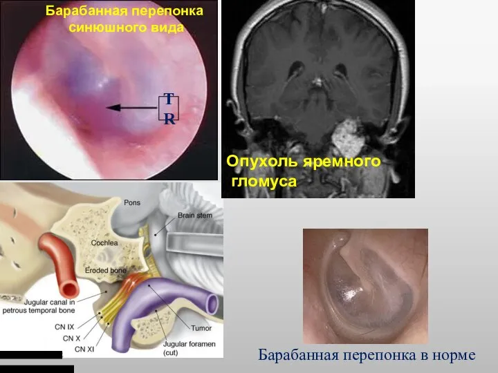 TR Опухоль яремного гломуса Барабанная перепонка синюшного вида Барабанная перепонка в норме