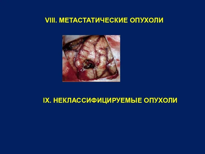 VIII. МЕТАСТАТИЧЕСКИЕ ОПУХОЛИ IX. НЕКЛАССИФИЦИРУЕМЫЕ ОПУХОЛИ