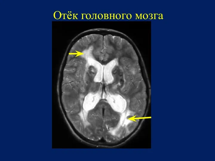 Отёк головного мозга