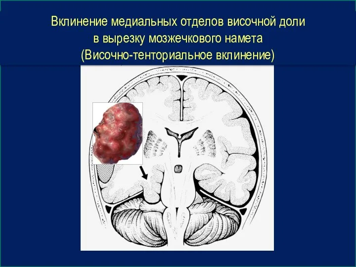 Вклинение медиальных отделов височной доли в вырезку мозжечкового намета (Височно-тенториальное вклинение)