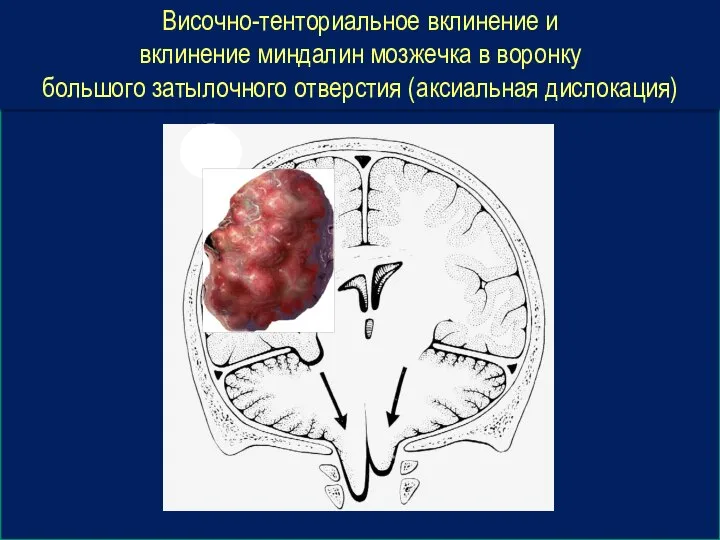 Височно-тенториальное вклинение и вклинение миндалин мозжечка в воронку большого затылочного отверстия (аксиальная дислокация)