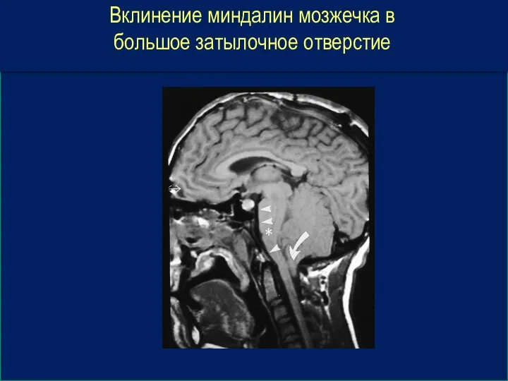 Вклинение миндалин мозжечка в большое затылочное отверстие