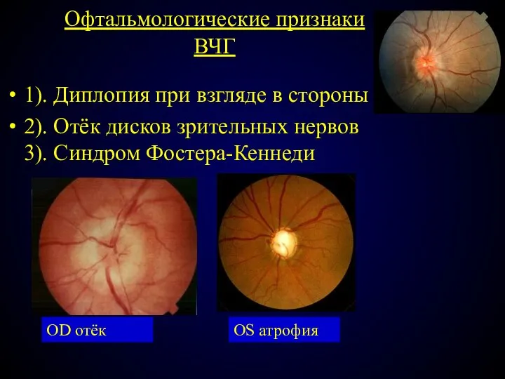 Офтальмологические признаки ВЧГ 1). Диплопия при взгляде в стороны 2). Отёк