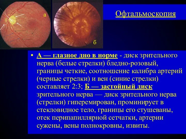 Офтальмоскопия А — глазное дно в норме - диск зрительного нерва