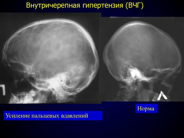 Внутричерепная гипертензия (ВЧГ) Усиление пальцевых вдавлений Норма