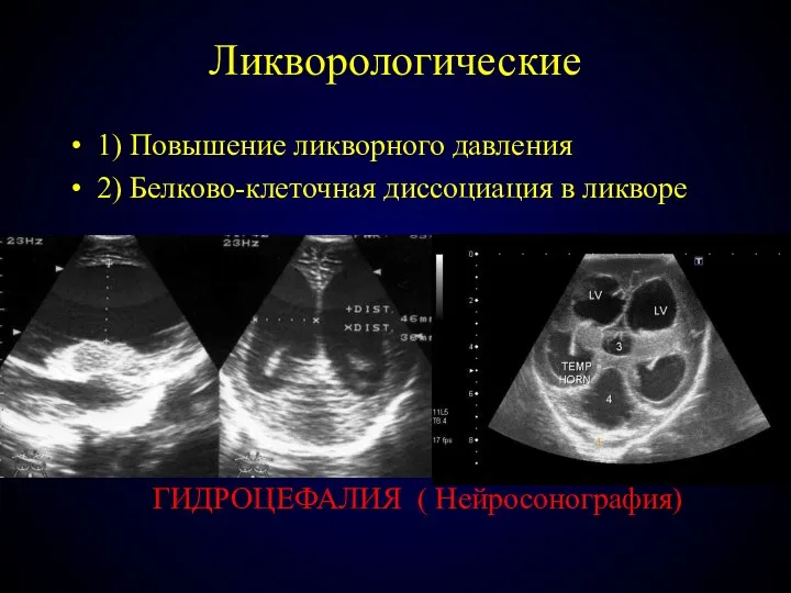 Ликворологические 1) Повышение ликворного давления 2) Белково-клеточная диссоциация в ликворе ГИДРОЦЕФАЛИЯ ( Нейросонография)