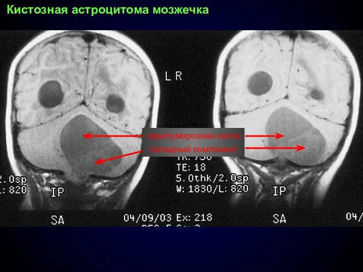 Кистозная астроцитома мозжечка