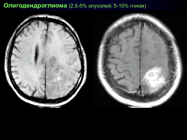 Олигодендроглиома (2.5-5% опухолей; 5-10% глиом) полушарная (корково-подкорковая) локализация линейные/извитые петрификаты медленный