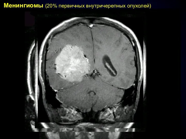 Менингиомы (20% первичных внутричерепных опухолей)