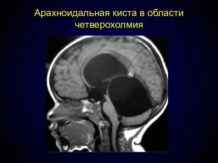 Арахноидальная киста в области четверохолмия