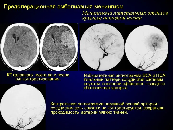 Предоперационная эмболизация менингиом