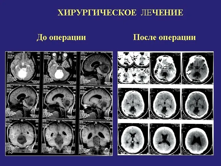 До операции После операции ХИРУРГИЧЕСКОЕ ЛЕЧЕНИЕ